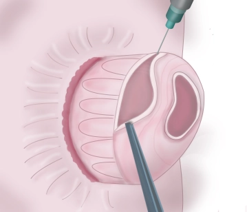 Dissecting the rectal mucosa off the muscle layer