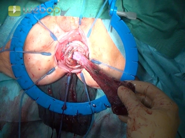 Cylindrical dissection of the rectal mucosa