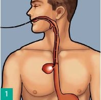 Transmural esophageal defects