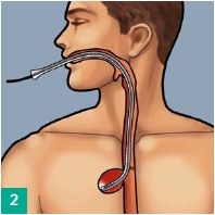 Visualizing and placing the overtube into the leakage cavity