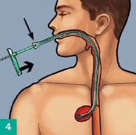 Inserting the sponge