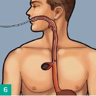 Endoscopic vacuum therapy in upper GI tract perforation and staple line failure 2