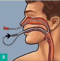 Transnasal routing