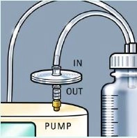 Endoscopic vacuum therapy in upper GI tract perforation and staple line failure 1