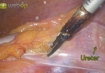 Mobilizing the left hemicolon and dissecting the upper rectum