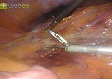Mobilizing the ascending colon and taking down the hepatic flexure