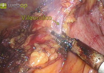 Dividing the ileocolic vessels