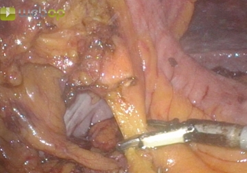 Dividing the right mesocolon