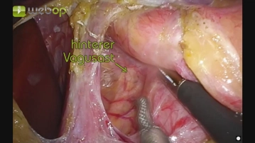Disección de los pilares diafragmáticos con exposición del esófago distal