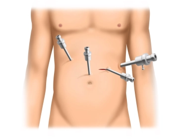 Insertion of Trocars and Exploration of the Gastroesophageal Junction