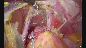 Anclaje transmural del 1.er electrodo