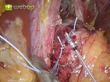 Fijación del electrodo