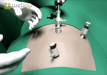 Dissecting the preperitoneal space and inserting the third trocar