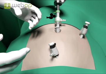 Preparation of the Extraperitoneal Space with Insertion of the Third Trocar