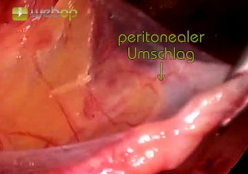 Freeing the hernial sac from the structures of the spermatic cord