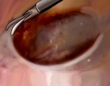 Dissecting off the peritoneum (parietalization)