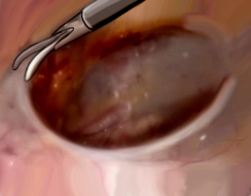 Dissecting off the peritoneum (parietalization)