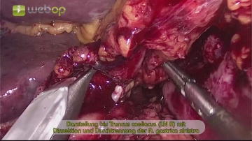 Exposing the celiac trunk (LN 8), dissecting and dividing the left gastric artery