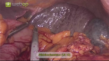 Dissecting the splenic hilum (LN 10)