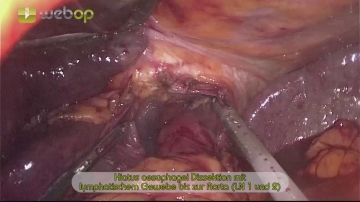 Dissecting the esophageal hiatus, including lymphadenectomy down to the aorta (LN 1 and 2)