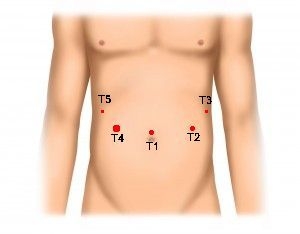 Trocar positioning