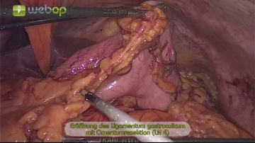 Incising the gastrocolic ligament and resecting the omentum (LN 4)