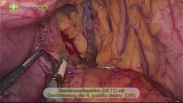 Dissecting the duodenum (LN 11) and transecting the right gastric artery