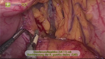 Dissecting the duodenum (LN 11) and transecting the right gastric artery
