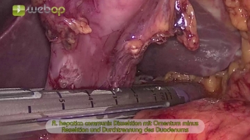 Dissecting the common hepatic artery, resecting  the lesser omentum and transecting the duodenum