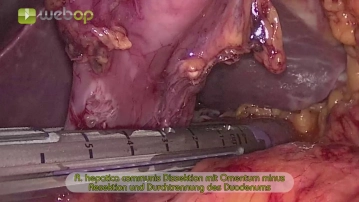 Dissecting the common hepatic artery, resecting  the lesser omentum and transecting the duodenum