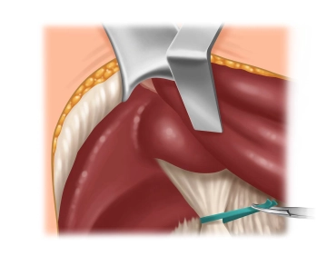 Preparación del hilio hepático