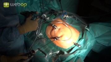 Creation of Pneumoperitoneum / Placement of Working Trocars