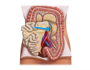 Dissecting on the Gerota fascia from medial and dividing the inferior mesenteric vein