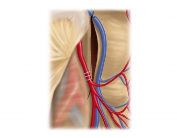 Dividing the inferior mesenteric artery