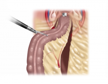  Dissecting the proximal rectum