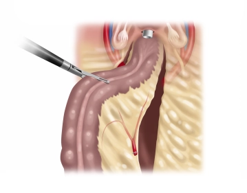 Preparación del recto proximal