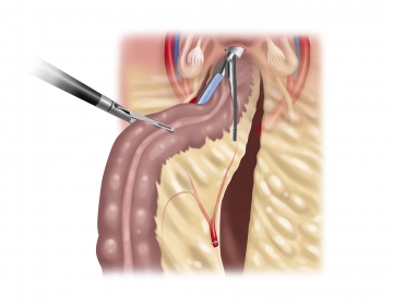 Transvaginal resection