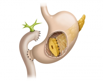 Suture fixation on the posterior gastric wall