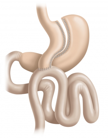 Transposition to the upper abdomen and gastroenterostomy