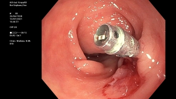 Exploration; intraoperative endoscopy