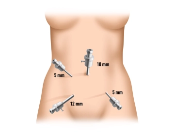 Placement of the trocars