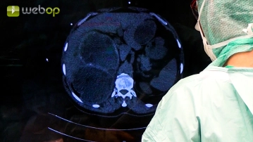 Evaluación de hallazgos; Adhesiolisis; Preparación libre del periquiste extrahepático en el lóbulo izquierdo del hígado