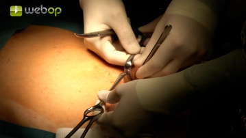 Positioning; Placement of the trocars