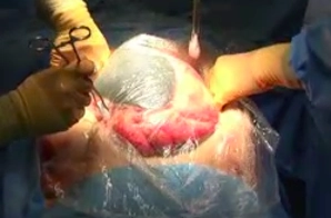 Insertion of the Intra-abdominal Component