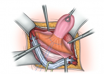 Hernia sac management in direct hernia