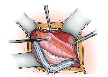 Division of the transversalis fascia