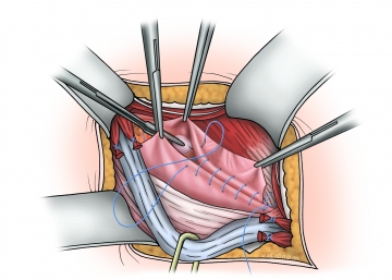 Shouldice suture line I