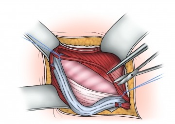 Mobilization and taping of the spermatic cord