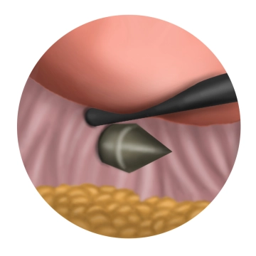 Introducción de los instrumentos vaginales