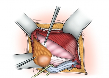 Preparation of the hernia sac